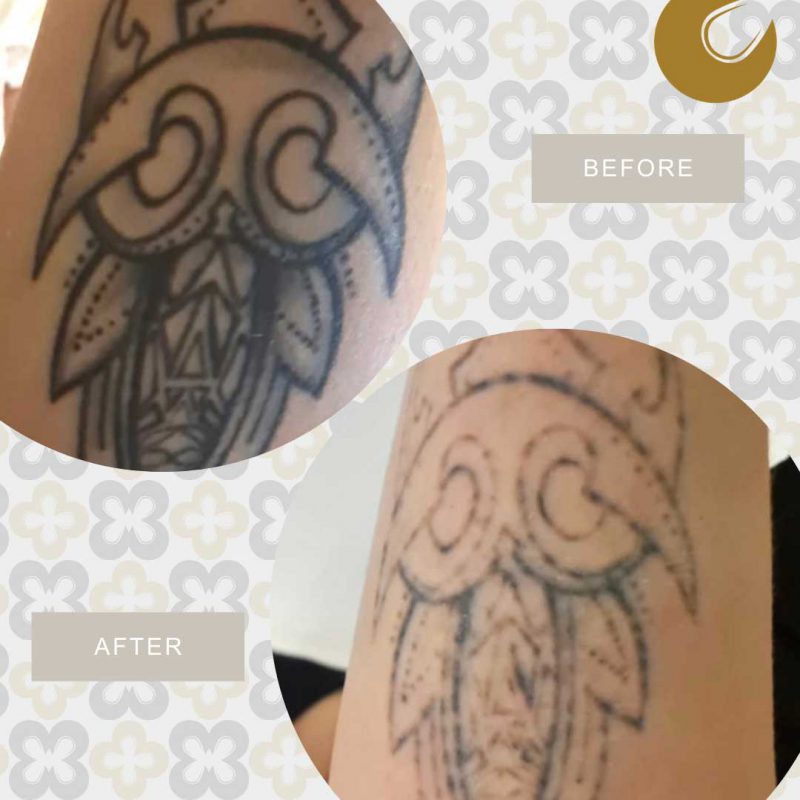 Resultaten laserbehandelingen Change Laserclinic